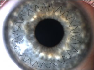 Queratoplastia